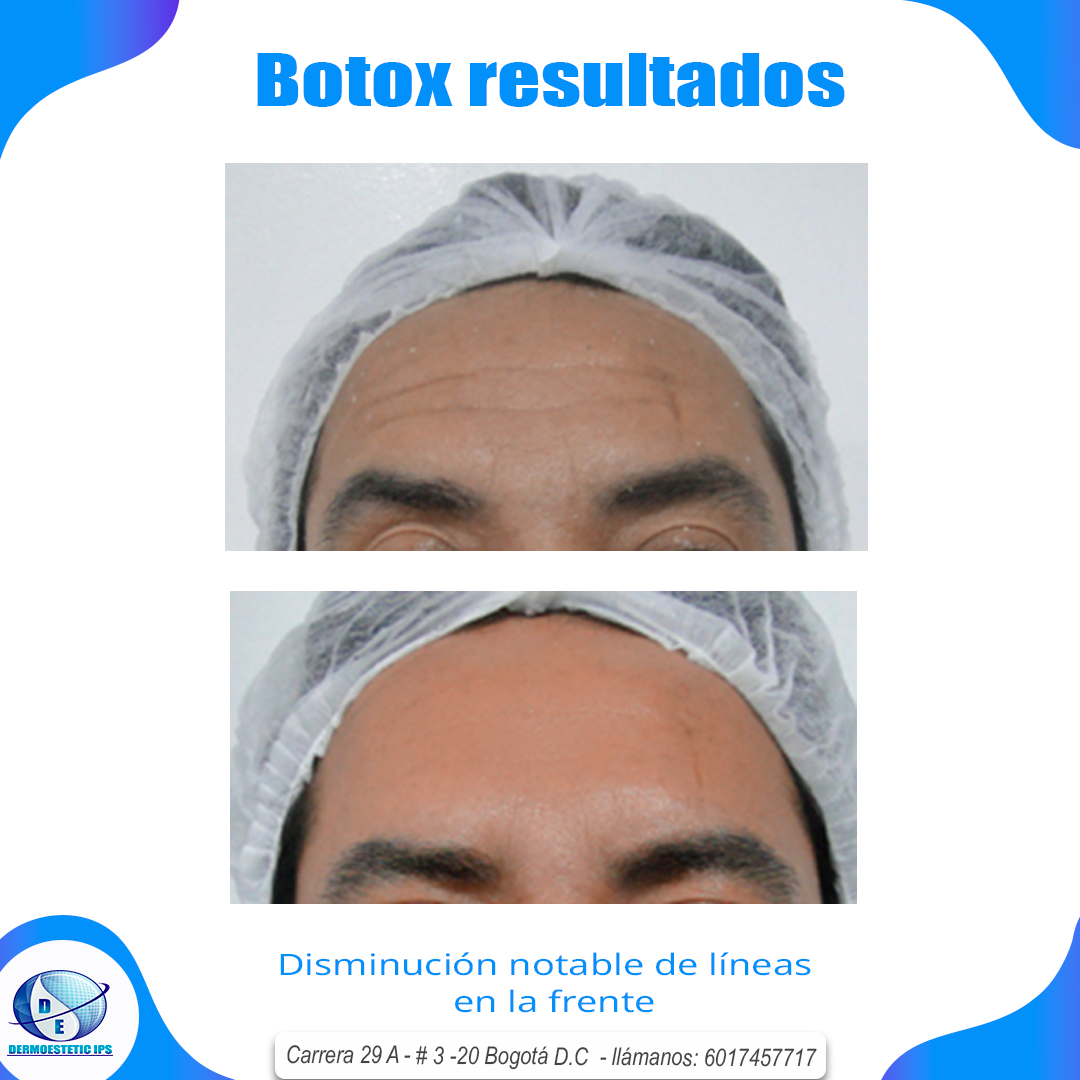Una foto de la frente de un hombre antes y después del botox.