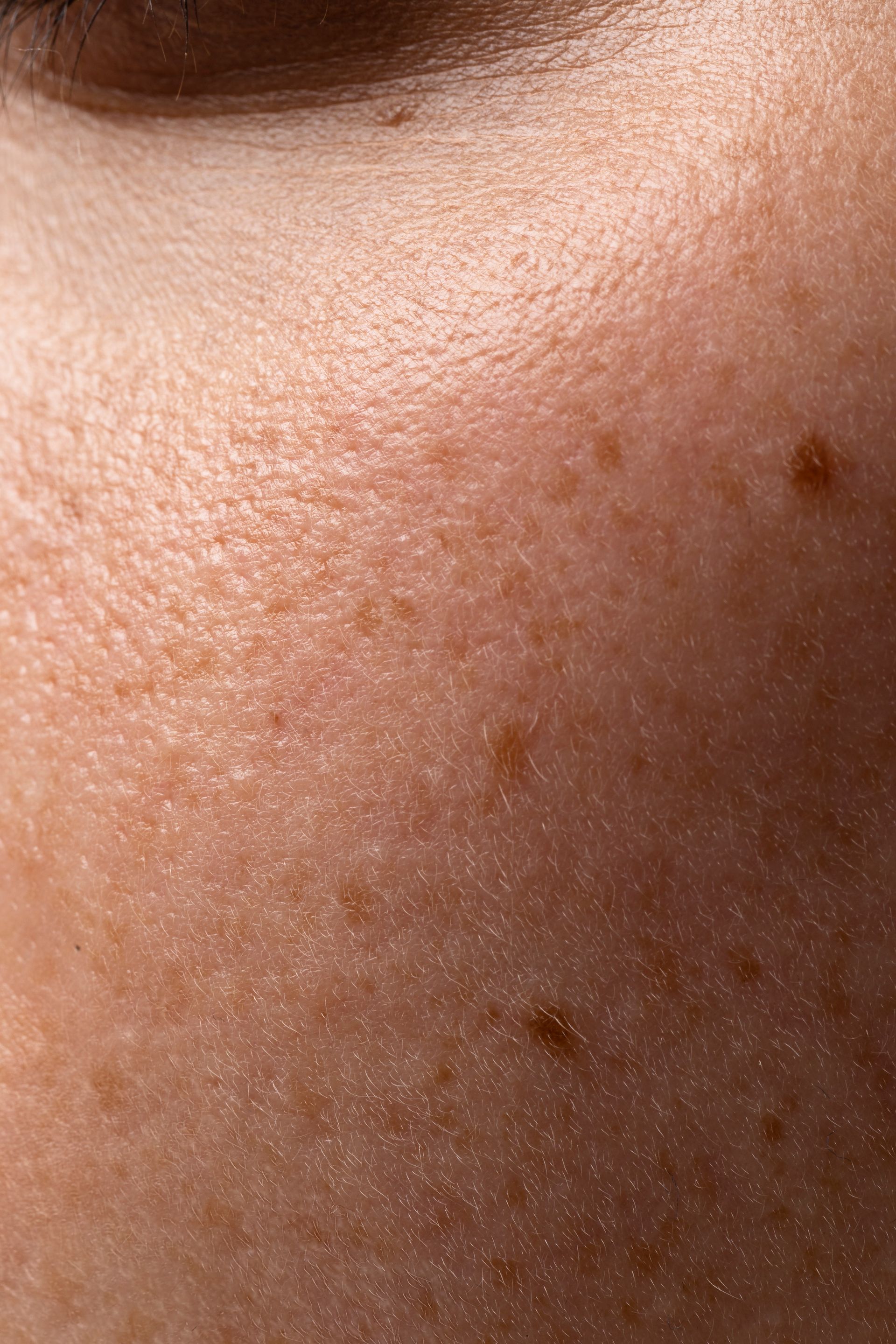 Una mujer recibe una inyección de botox en la cara.