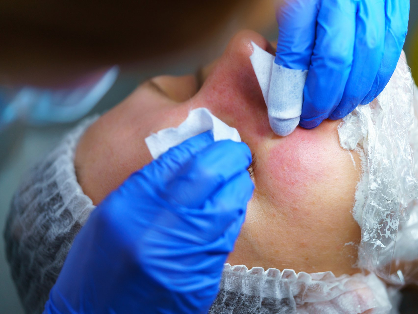 Una mujer recibe una inyección de botox en la cara.
