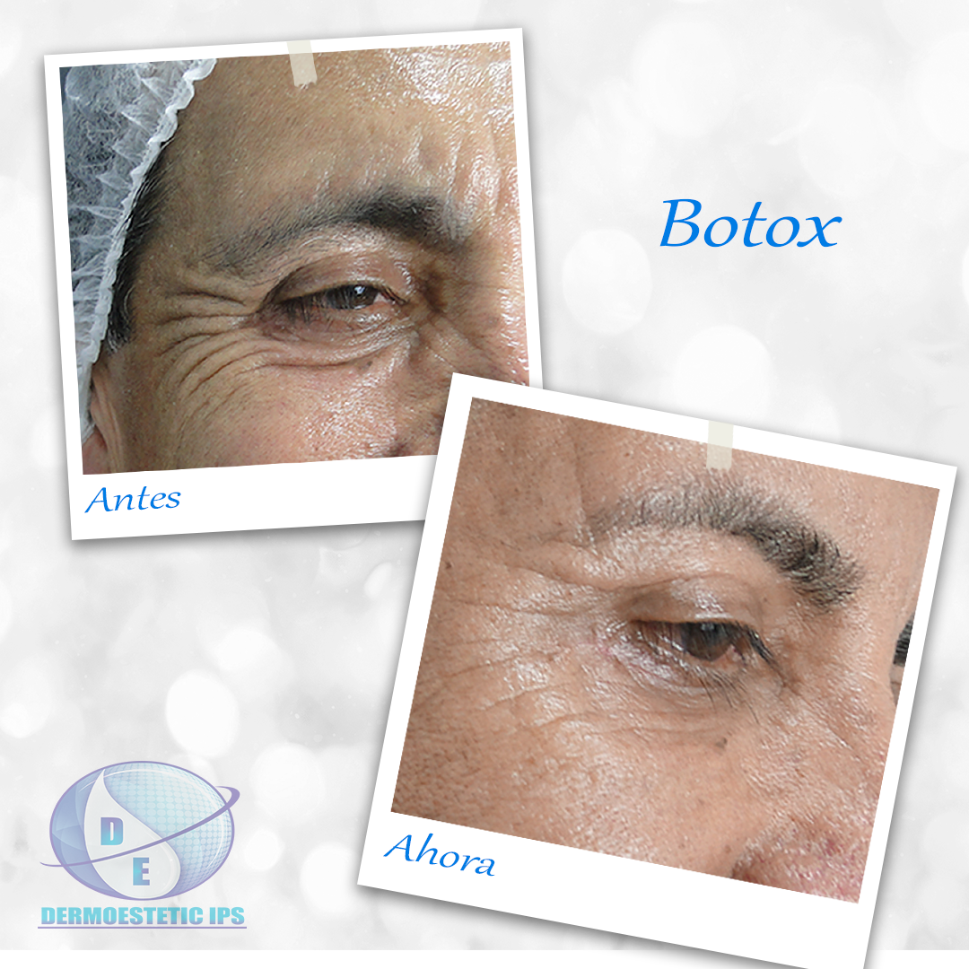 Dos fotografías de la cara de un hombre antes y después del botox.