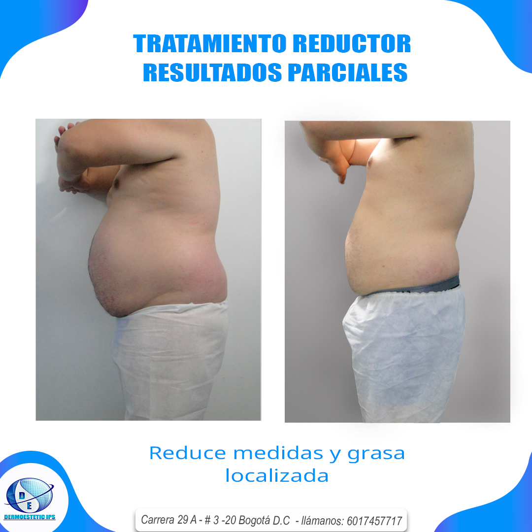 Una foto de antes y después del vientre de un hombre.