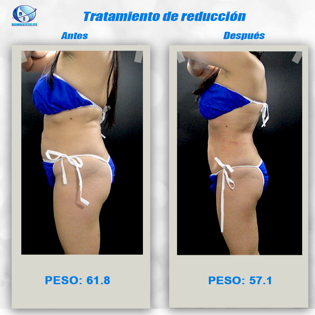 Se muestra a una mujer en bikini azul antes y después de perder peso.