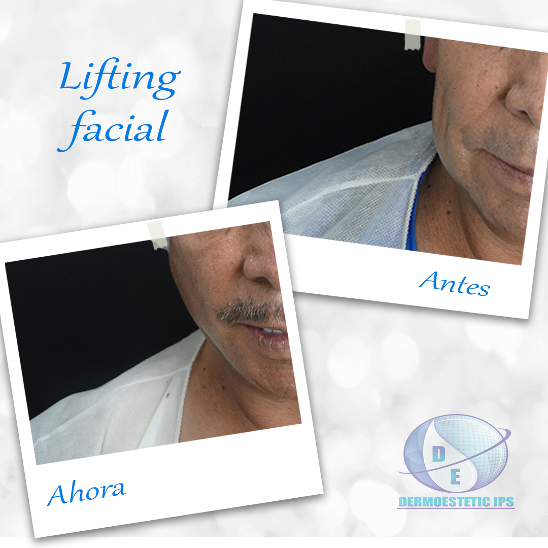 Una foto de antes y después de un lifting facial.