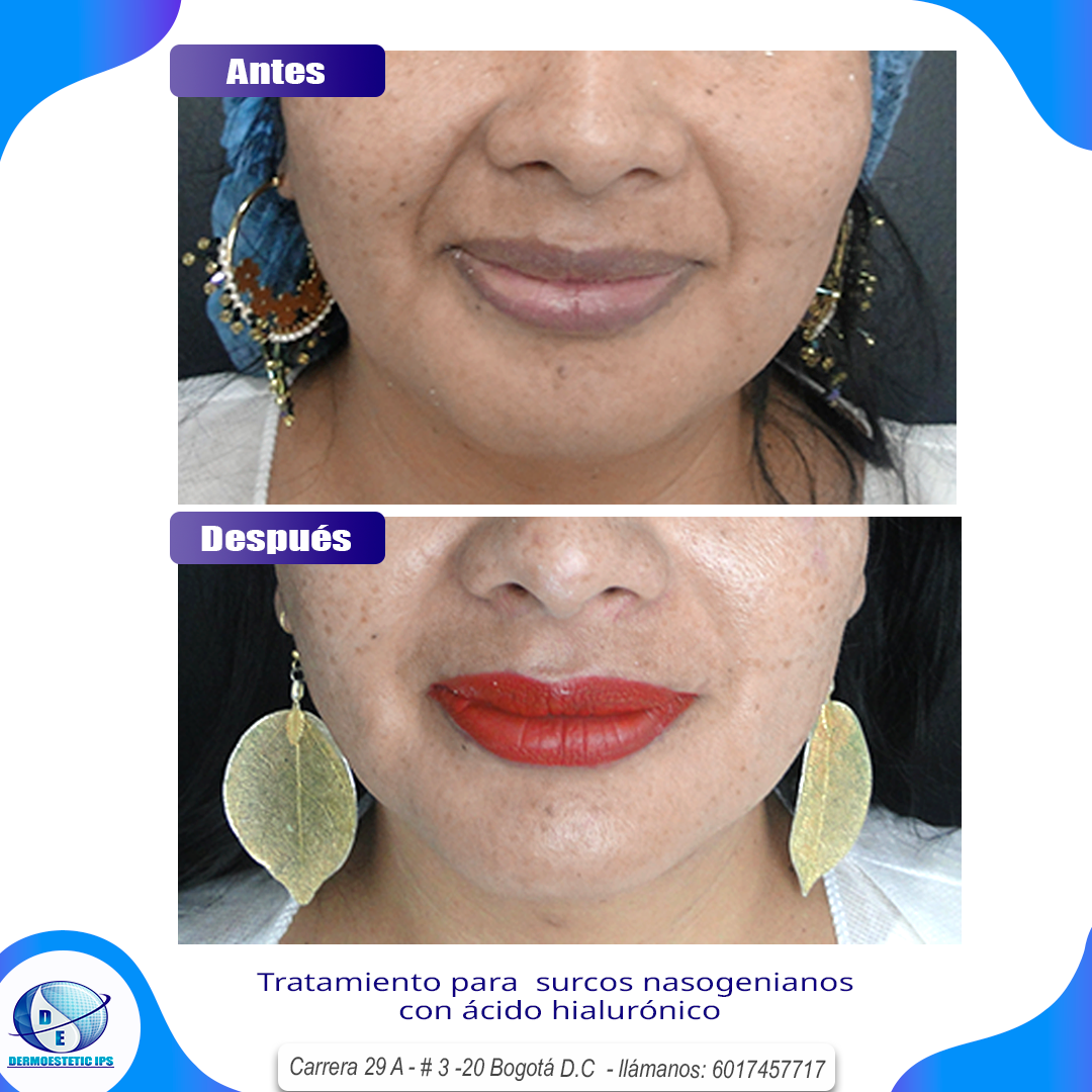 Una foto de antes y después de la cara de una mujer con labios rojos.