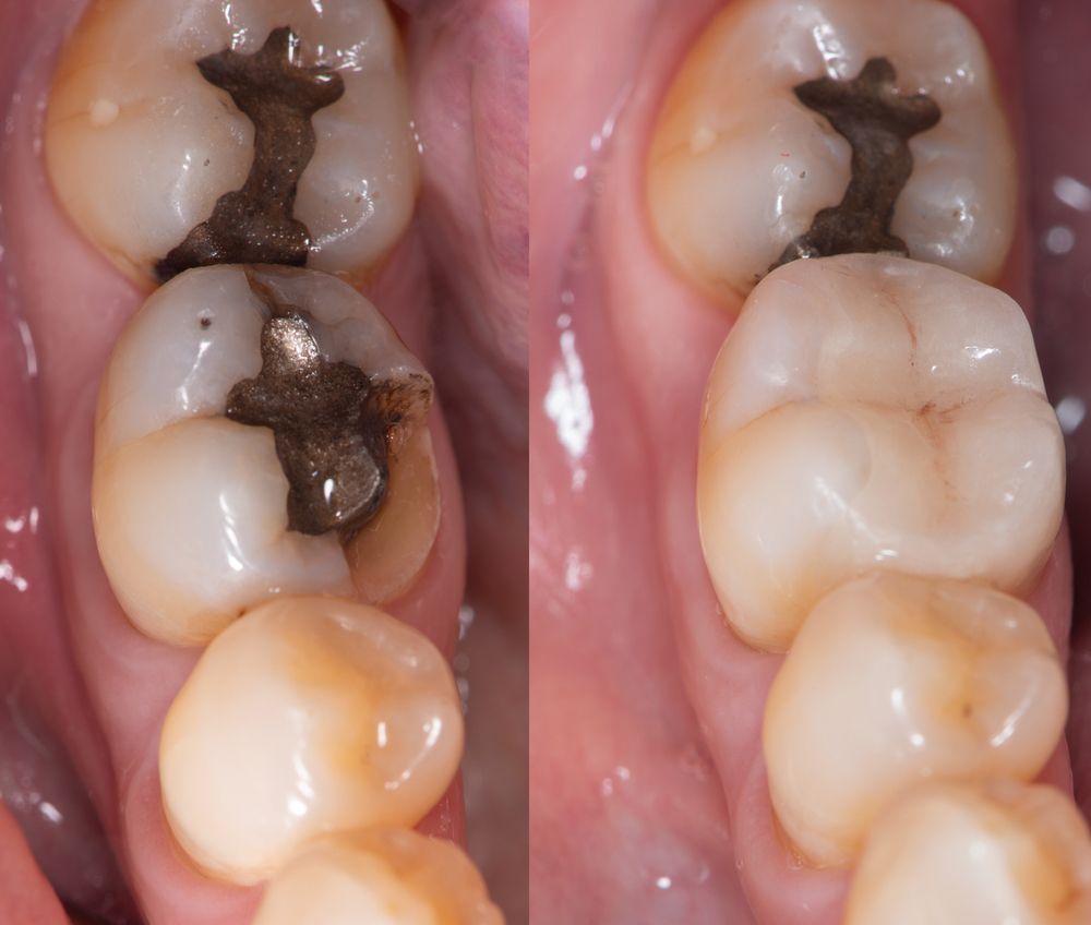 Une photo avant et après des dents d'une personne.