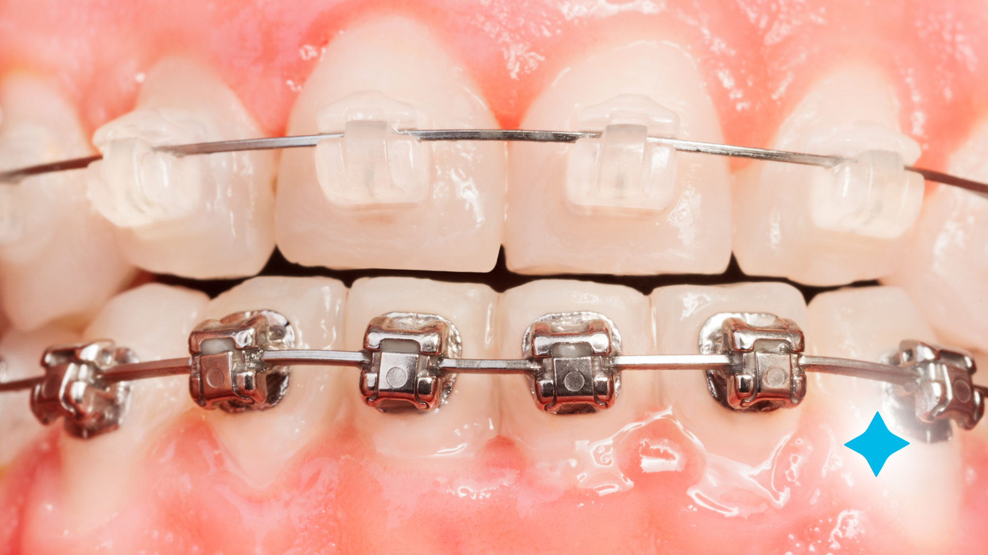 A close up of a person 's teeth with braces.