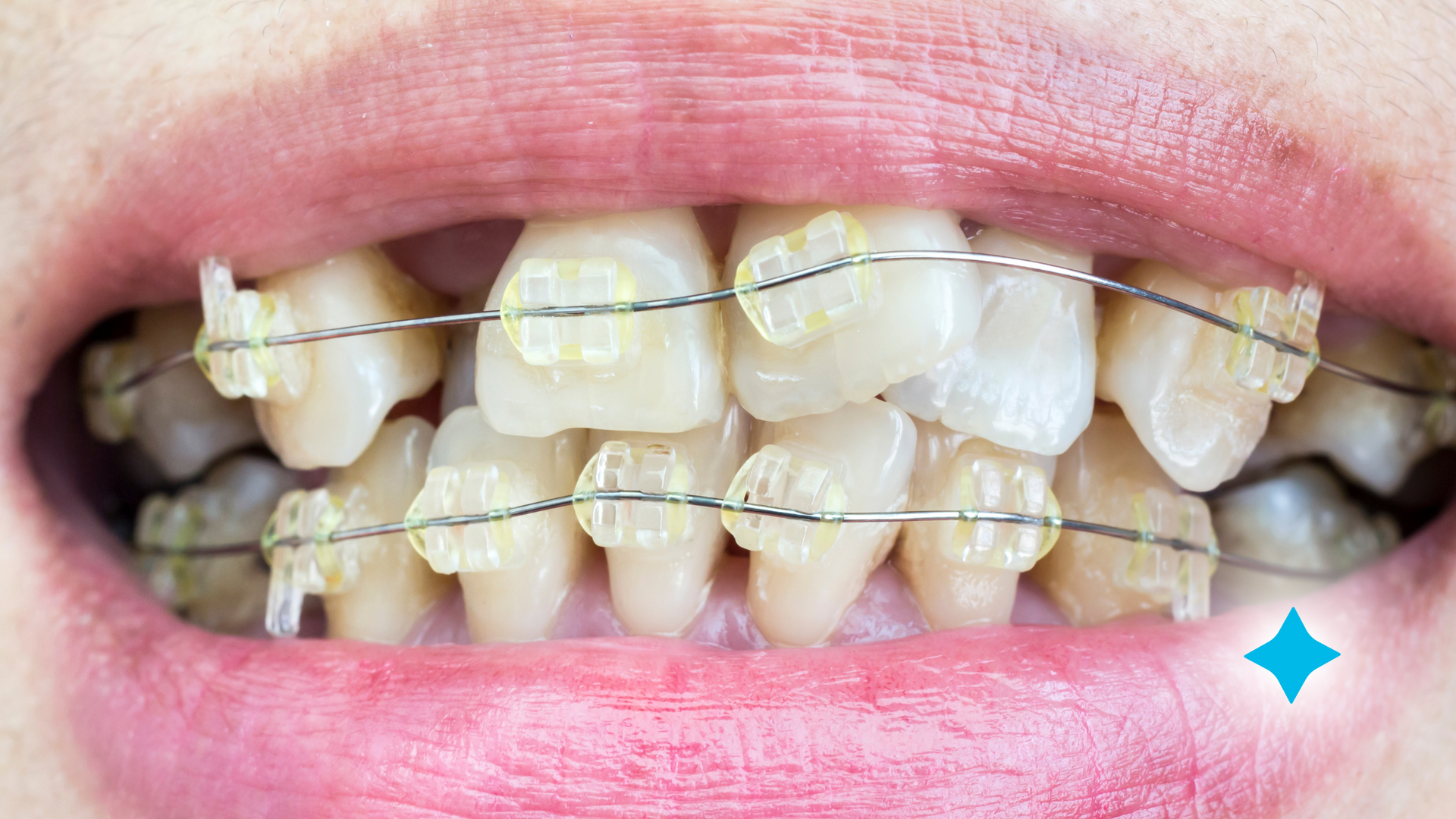 A close up of a person 's mouth with braces on their teeth.