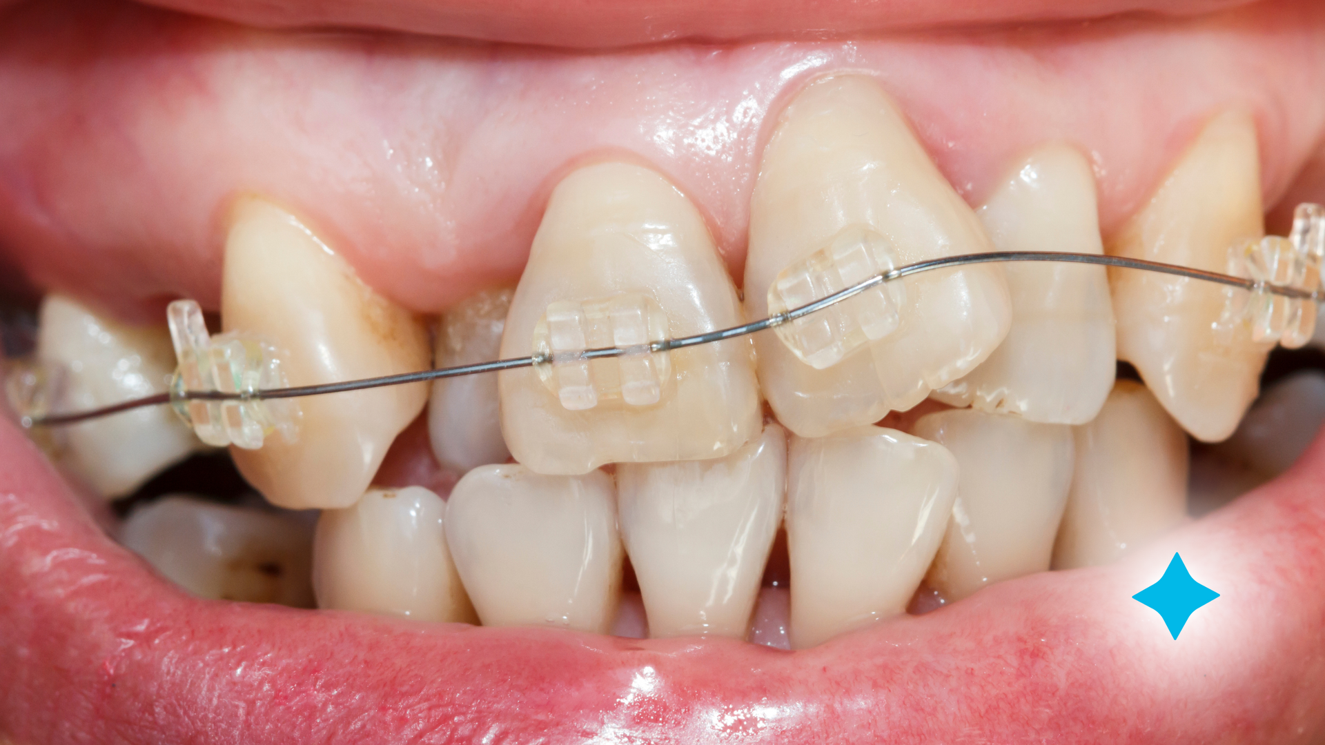 A close up of a person 's teeth with braces.