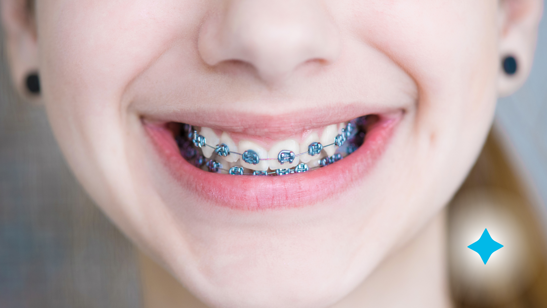 A close up of a woman 's mouth with braces on her teeth.