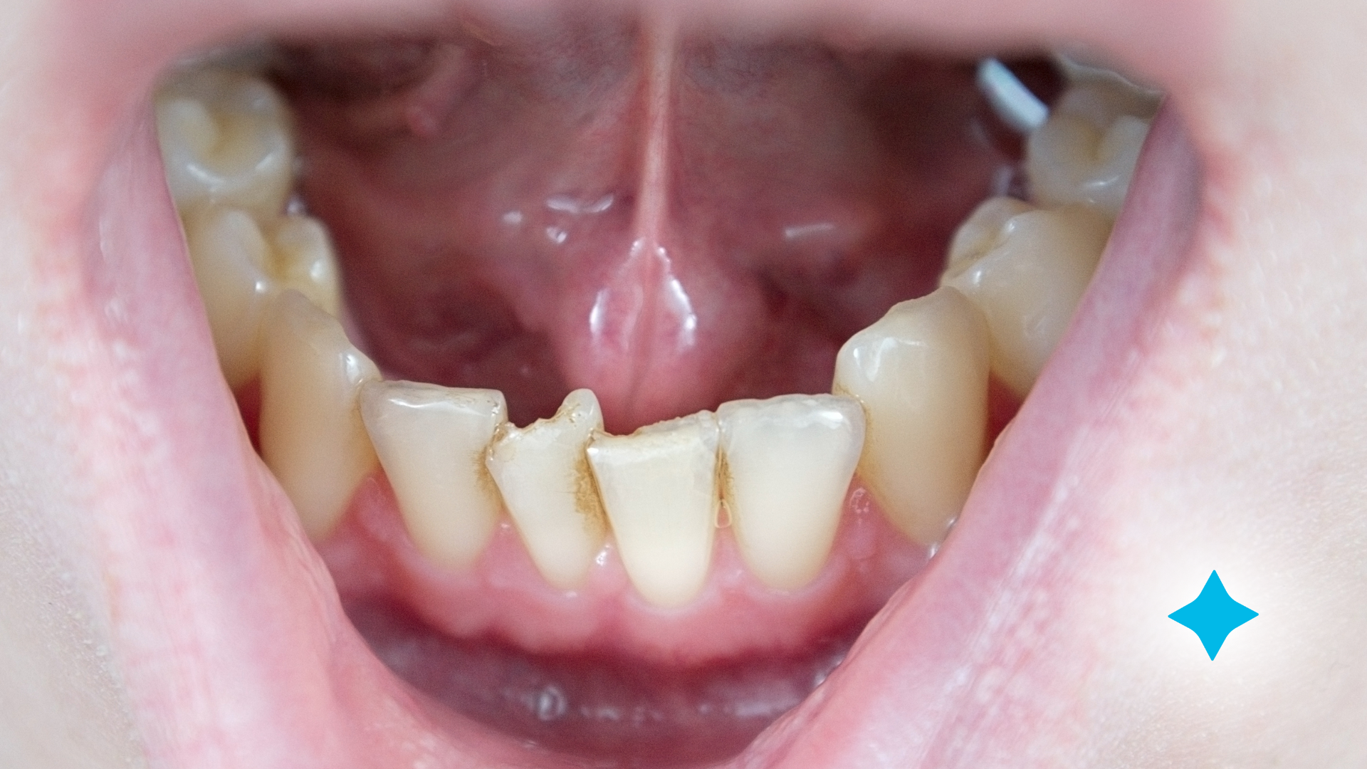 picture of crowded teeth