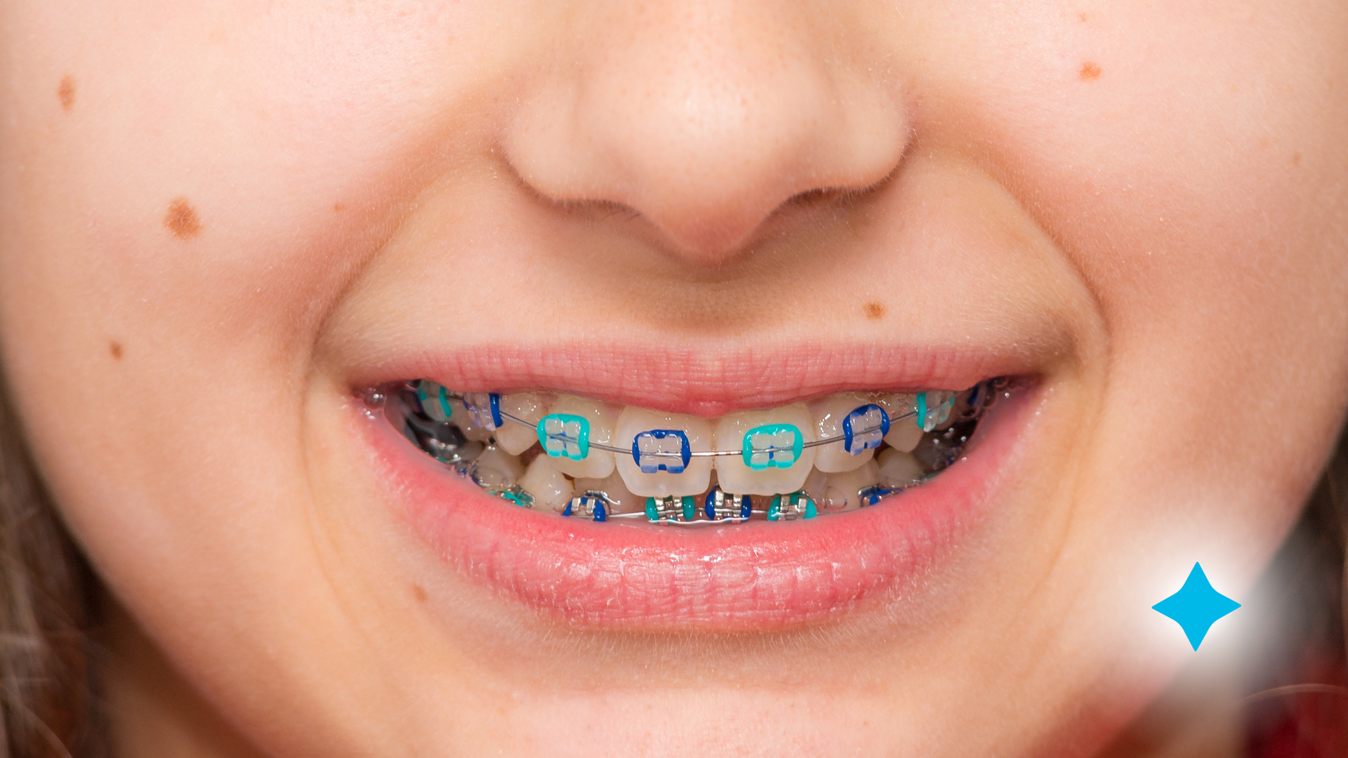 A close up of a child 's mouth with blue braces.