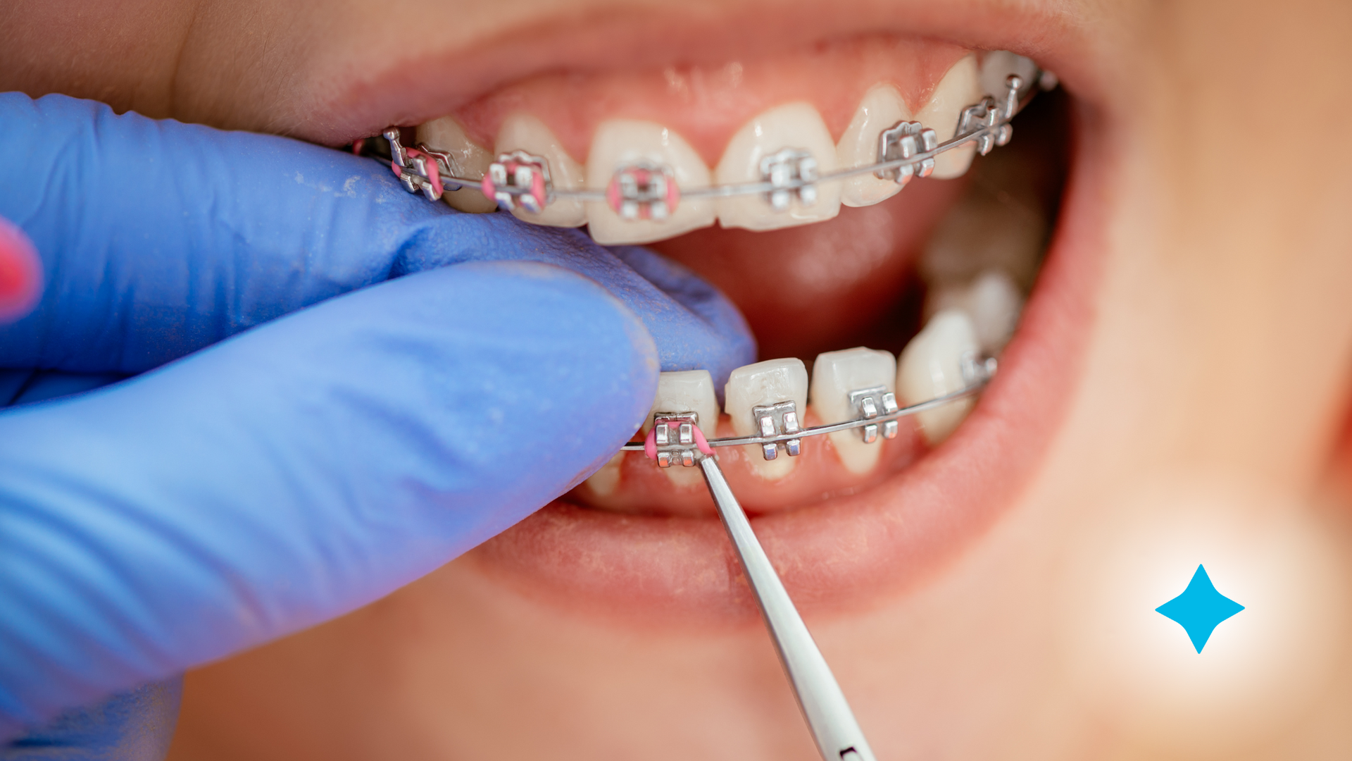 A close up of a person 's teeth with braces being cleaned by an orthodontist.