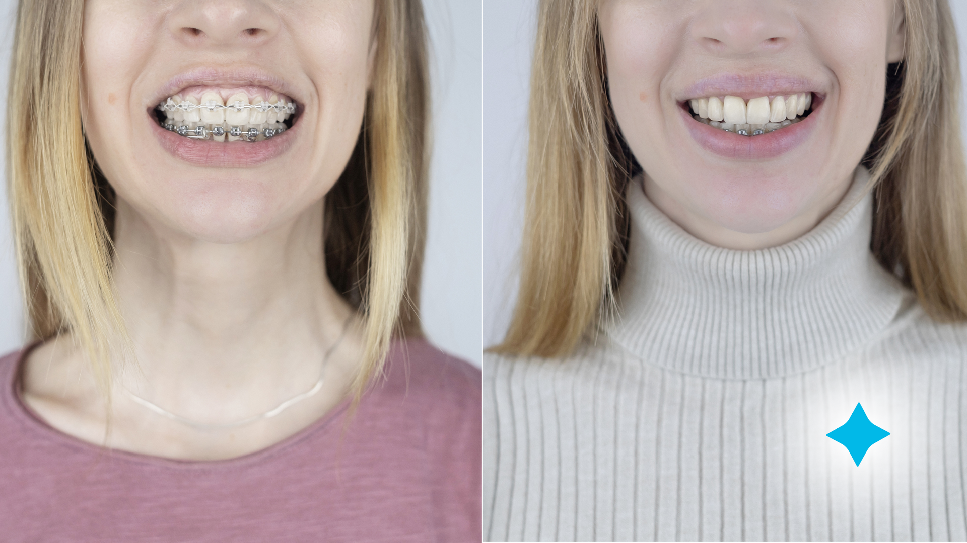 before and after braces comparison