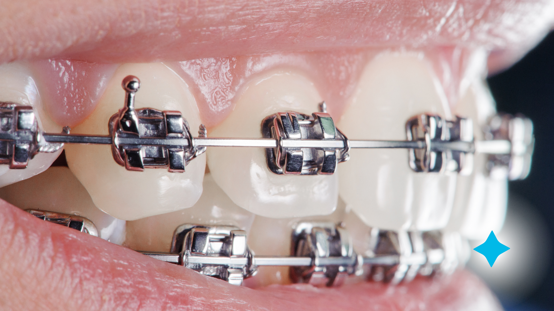 picture of braces