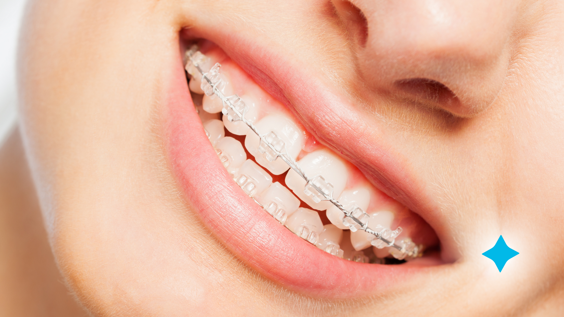 A close up of a woman 's smile with braces on her teeth.