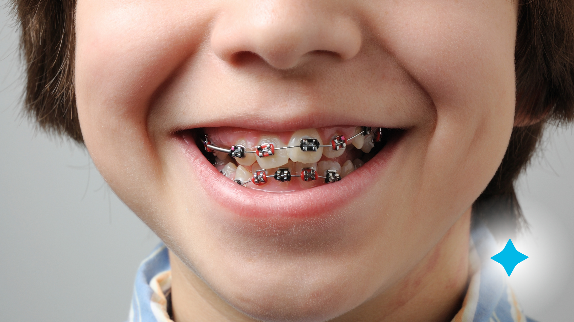 A young boy with braces on his teeth is smiling.