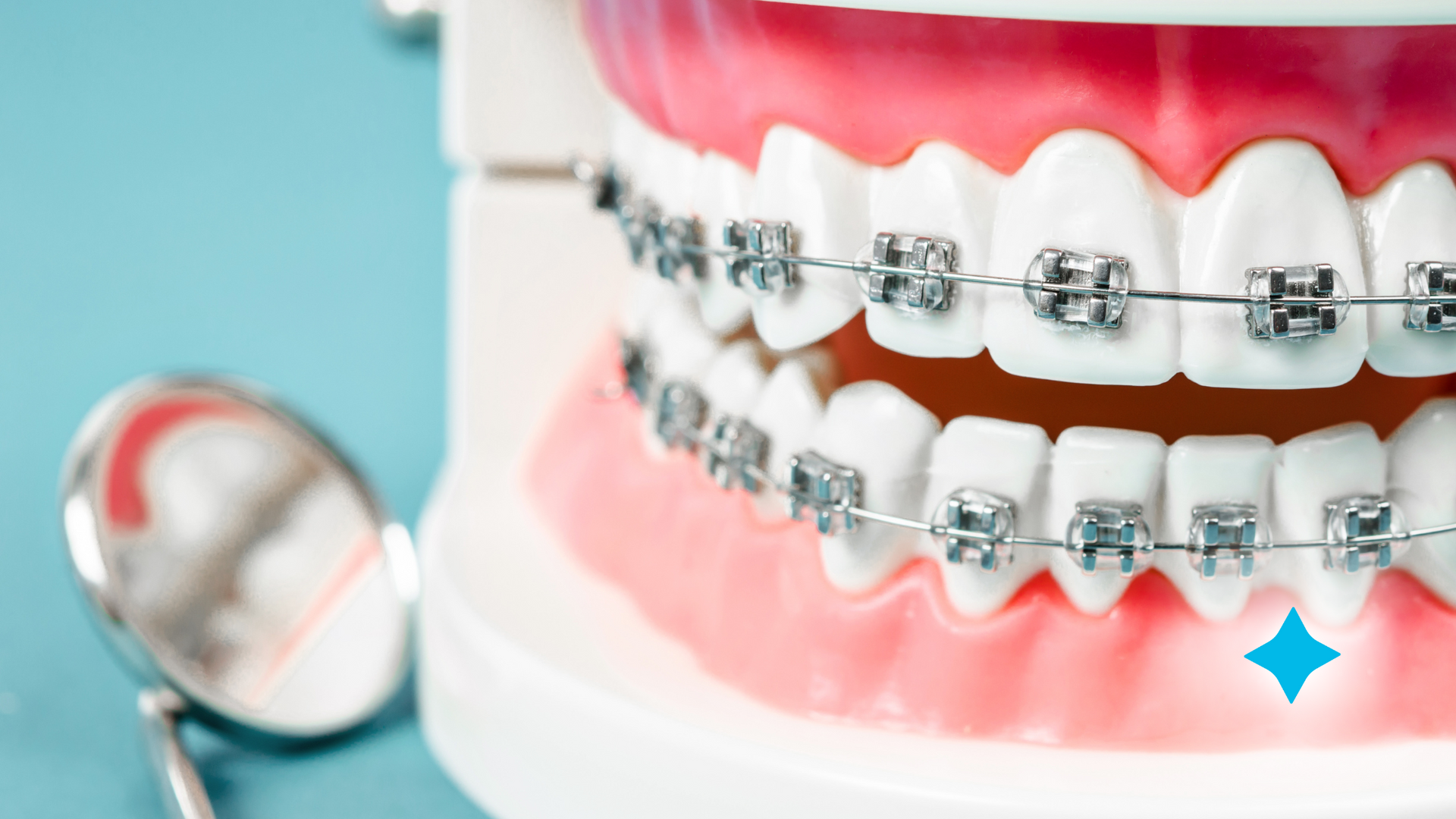 A model of a person 's teeth with braces and a dental mirror.