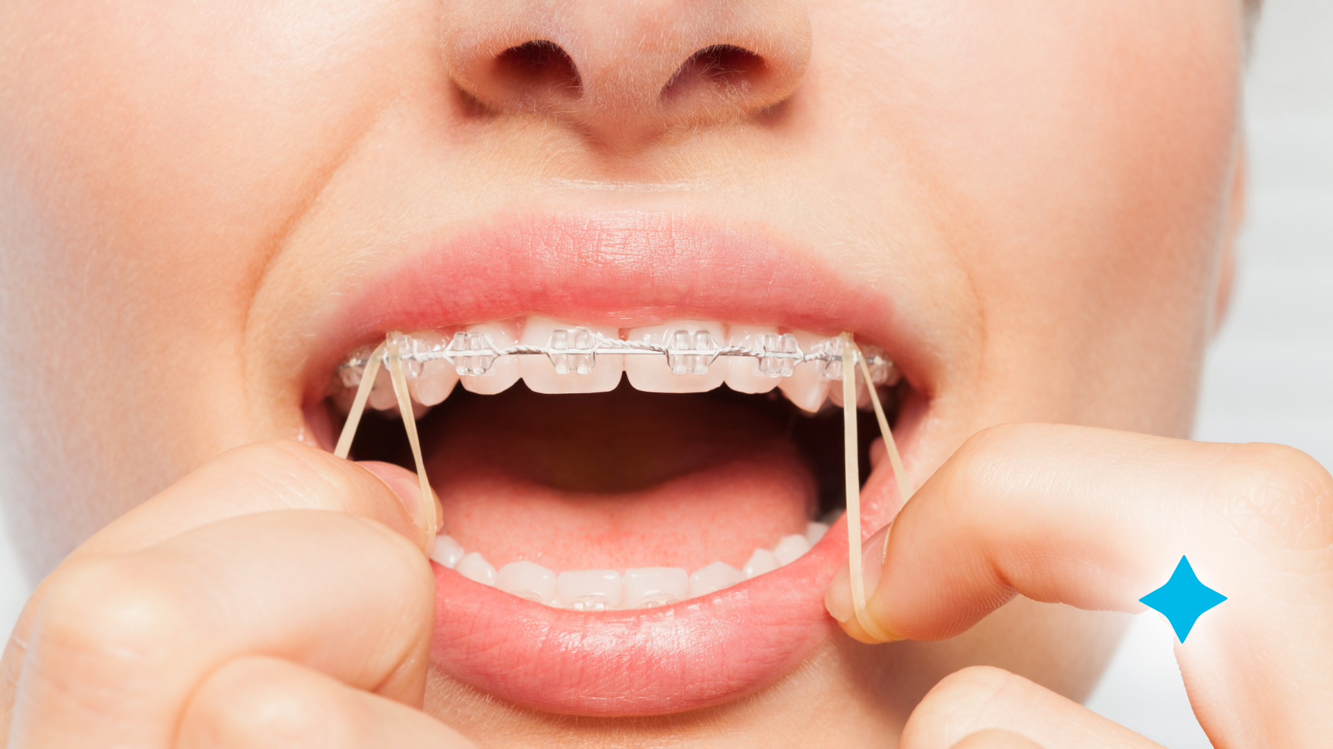 A woman with braces and rubber bands