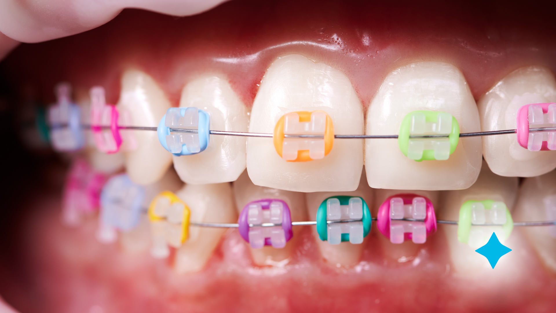 A close up of a person 's teeth with colorful braces.