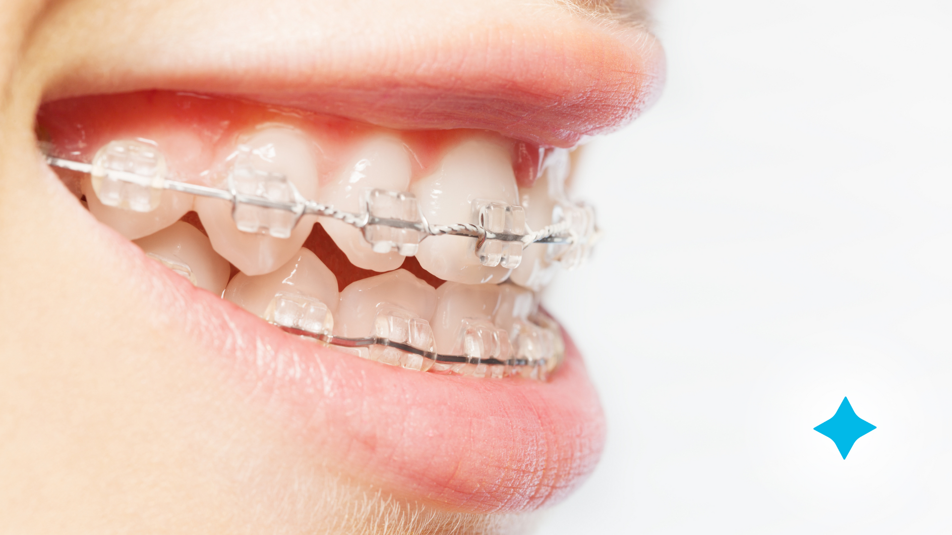 A close up of a person 's teeth with clear braces.
