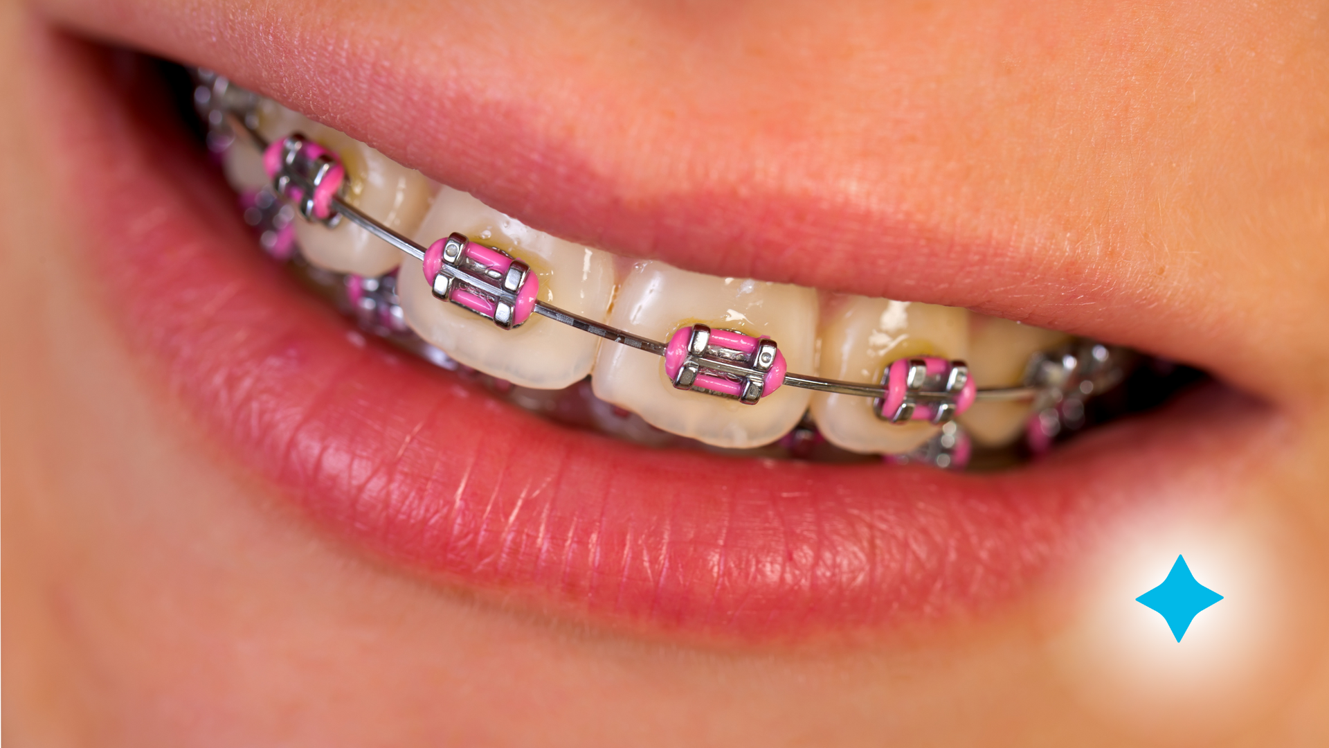 A close up of a person 's mouth with braces on their teeth.
