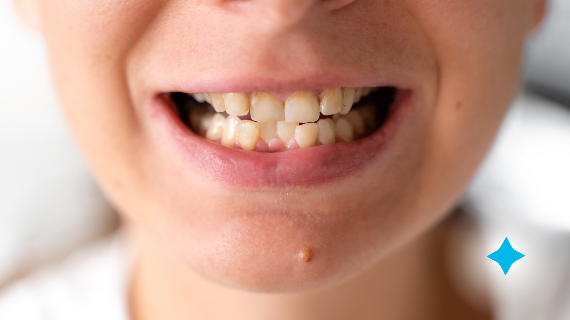 A close up of a woman's mouth with crooked teeth before braces.