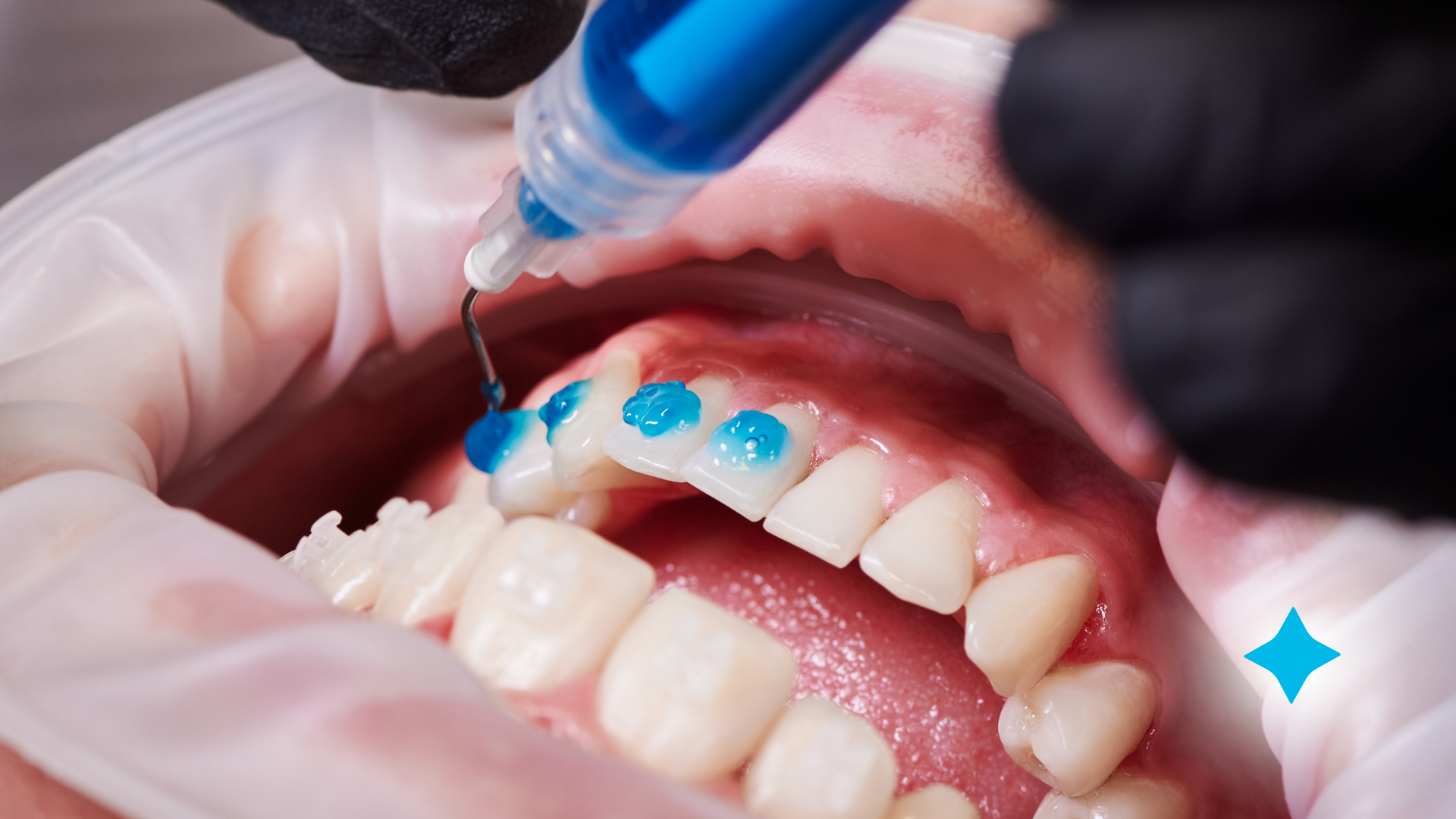 A close up of a person 's mouth with a syringe in it.