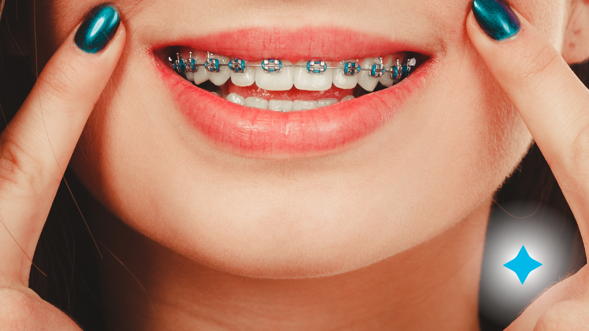 picture of smile with braces