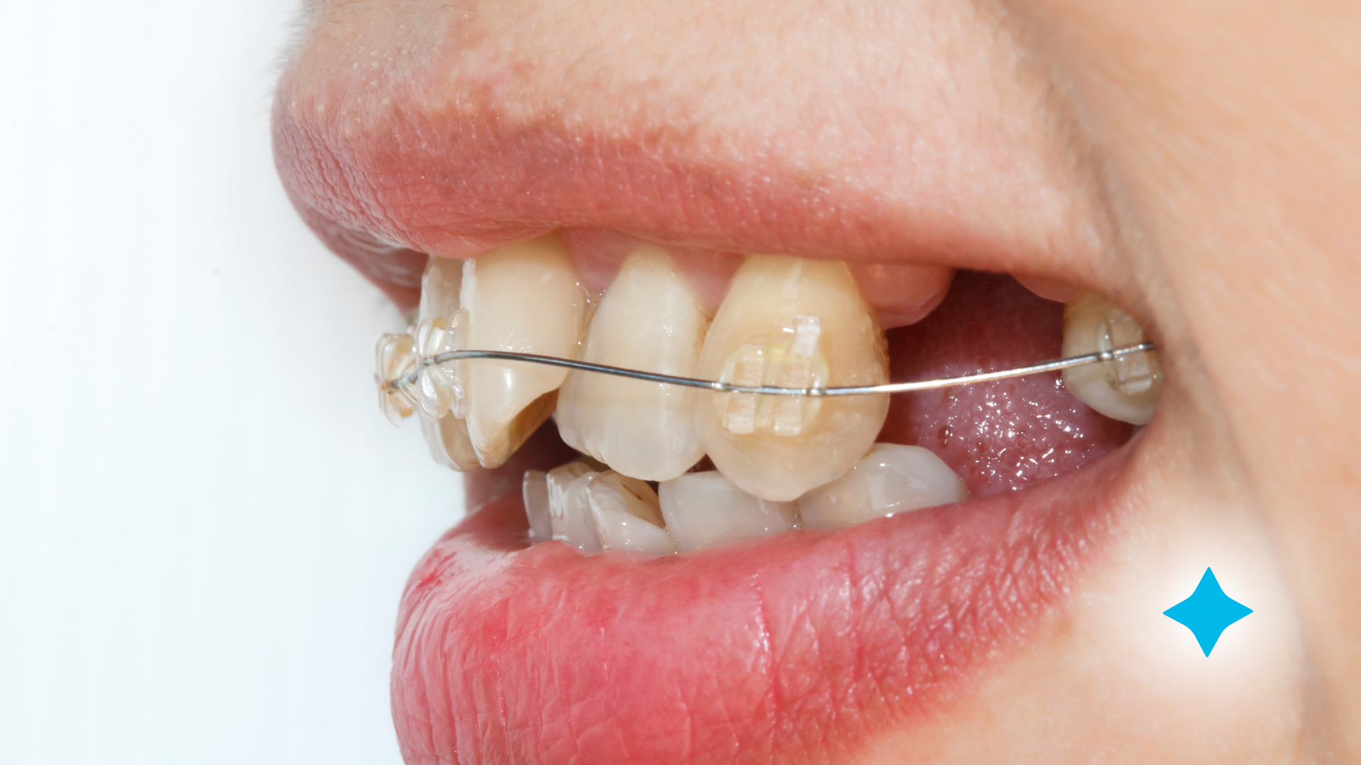A close up of a person 's mouth with braces on their teeth.