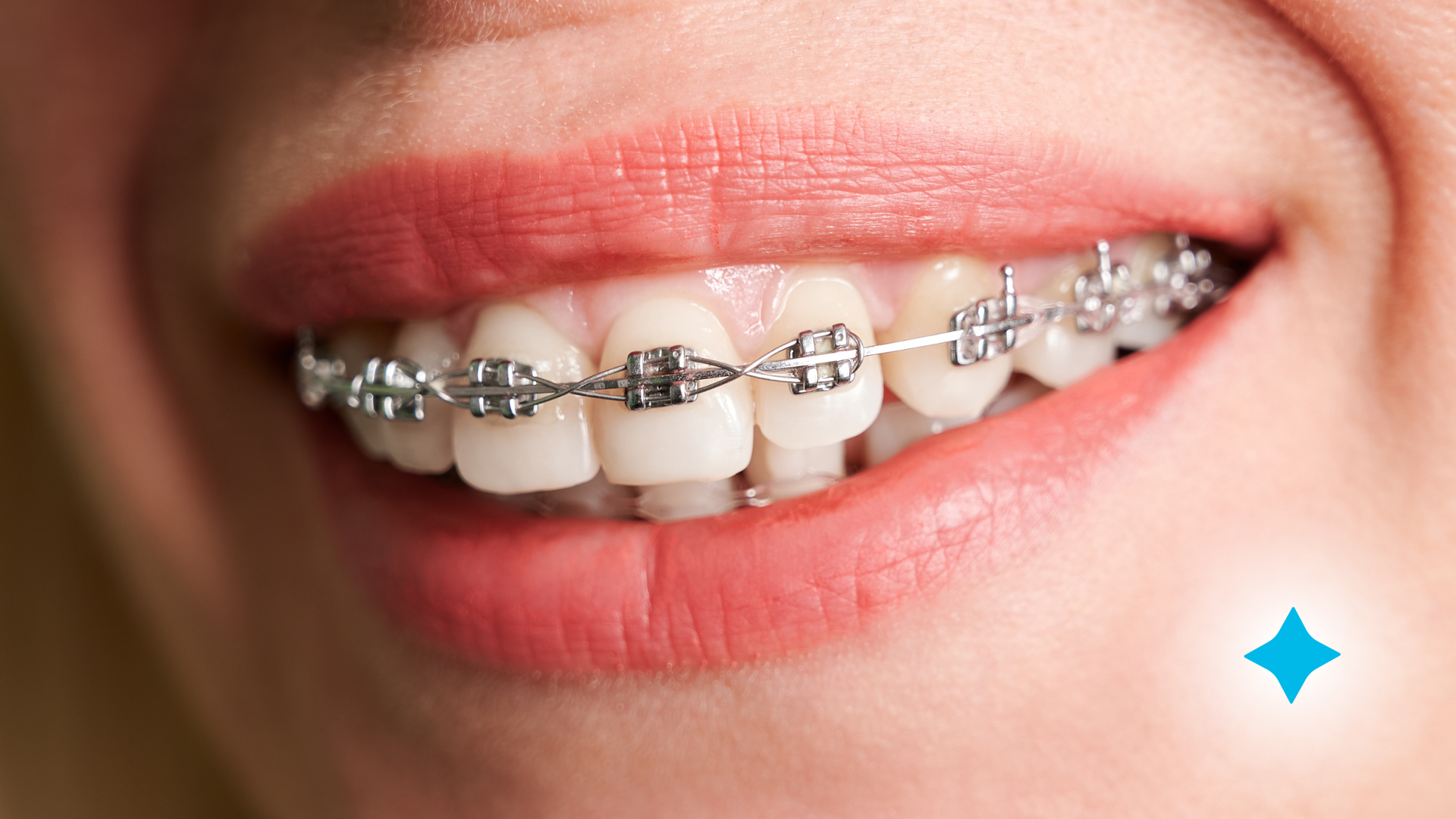 A close up of a woman 's mouth with braces on her teeth.