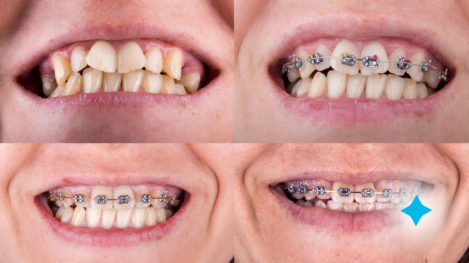 A woman 's teeth are shown before and after braces.