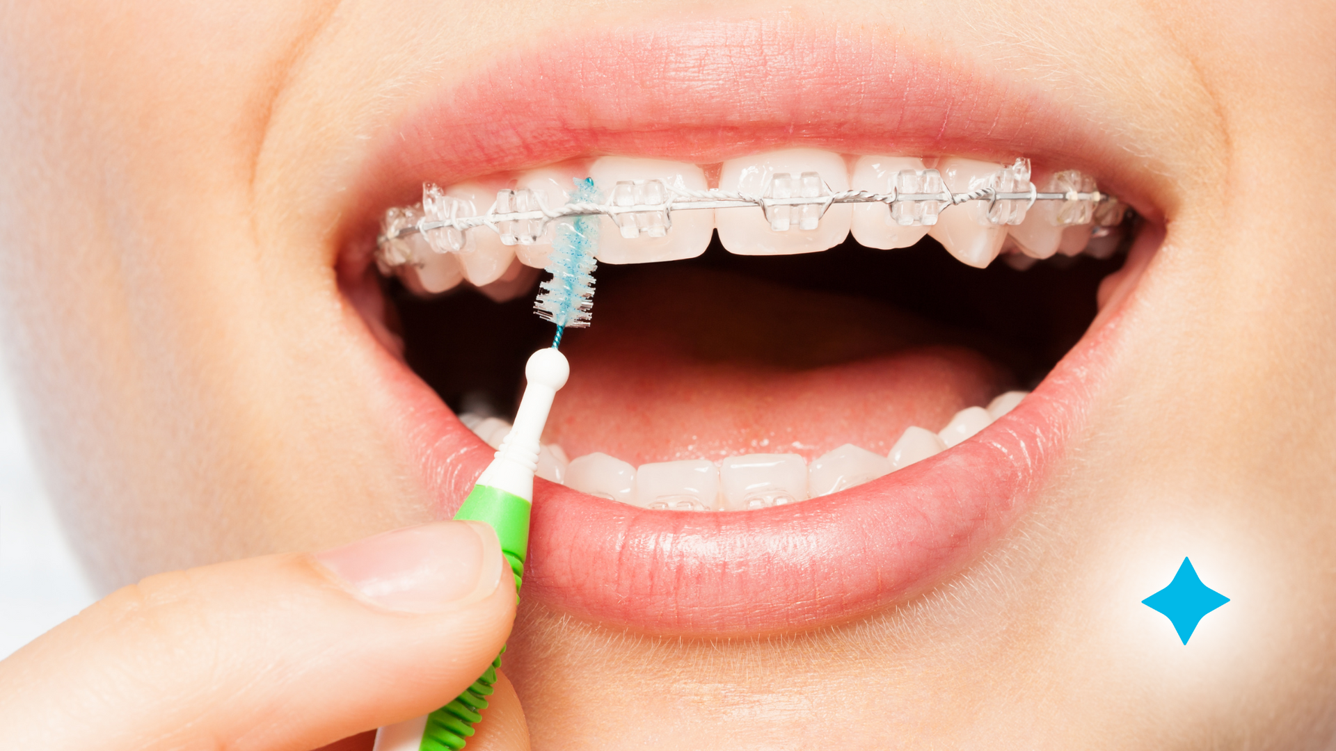 A person with braces is brushing their teeth with an interdental brush.