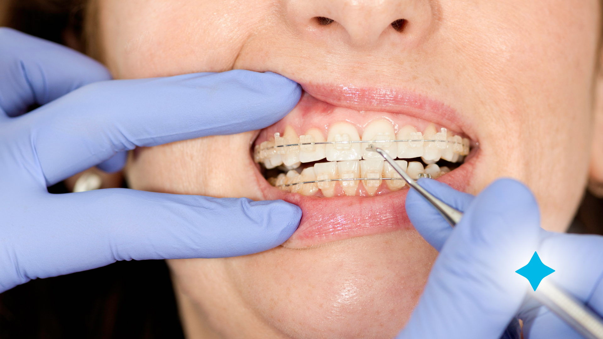 A woman with braces is getting her teeth examined by a dentist.