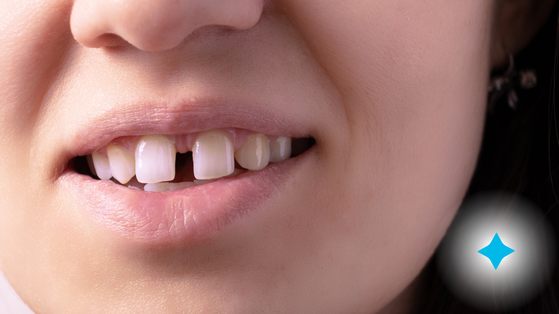 A close up of a woman 's mouth with missing teeth.