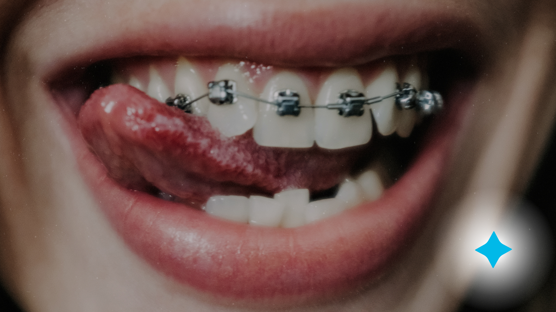 picture of smile with braces