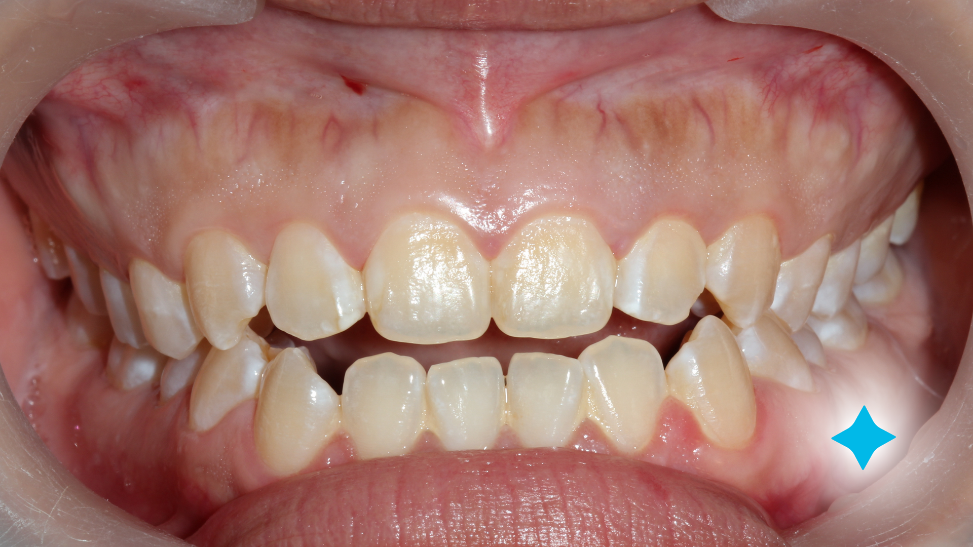 A close up of a person 's teeth with a blue diamond in the middle.