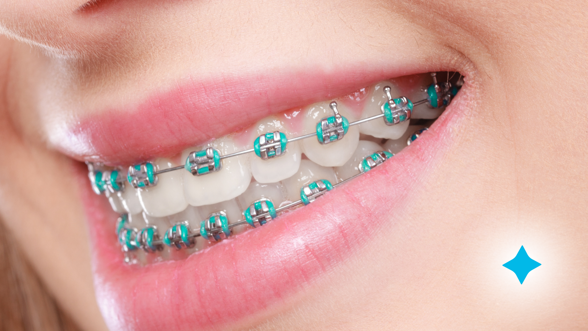 A close up of a woman 's teeth with blue braces.