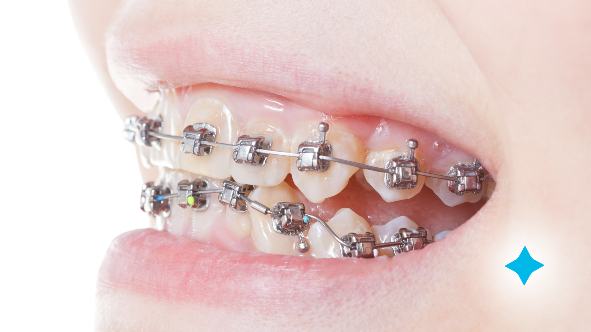 A close up of a person 's mouth with braces on their teeth.