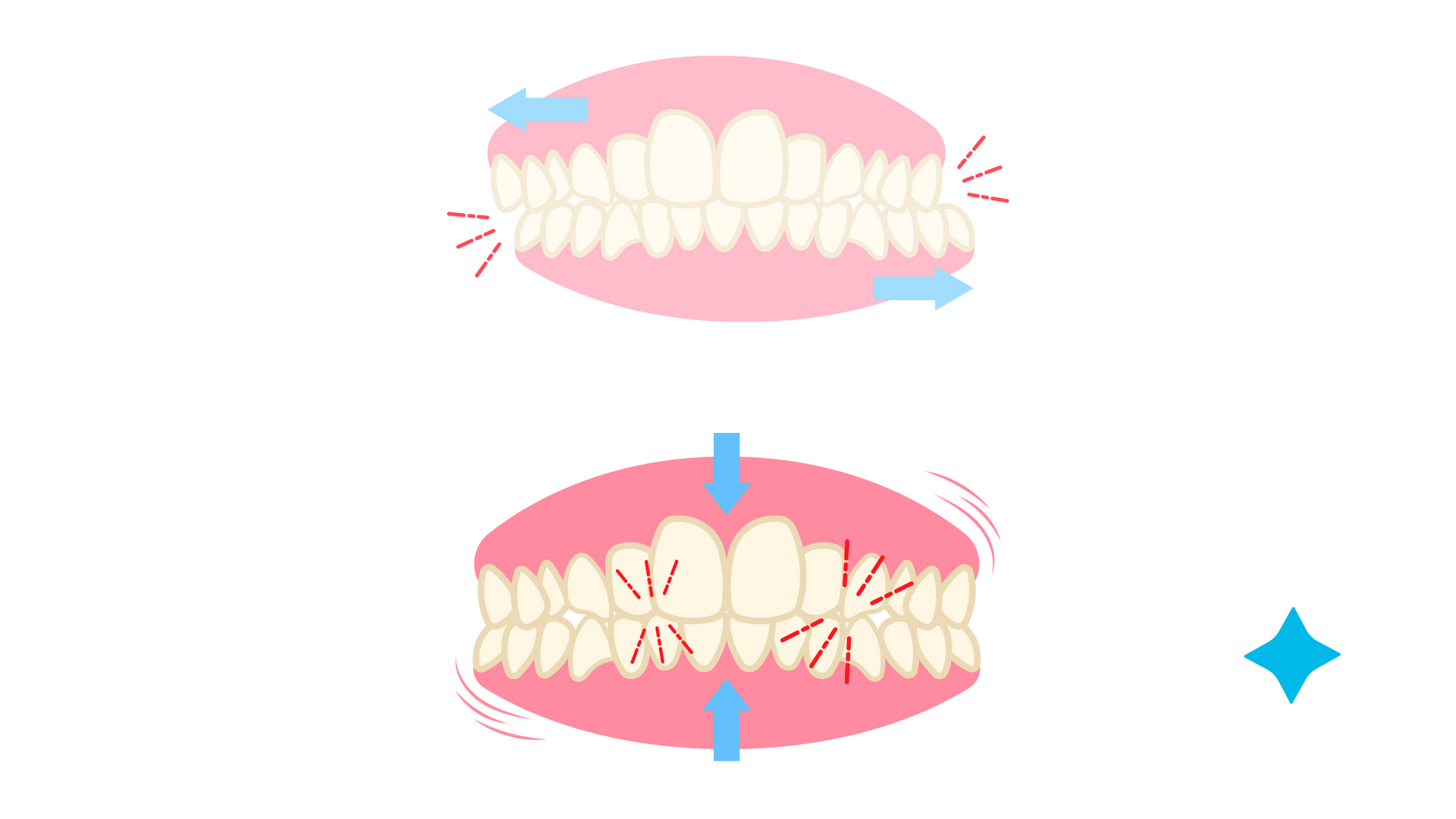 A cartoon illustration of a person 's teeth with arrows pointing in opposite directions.