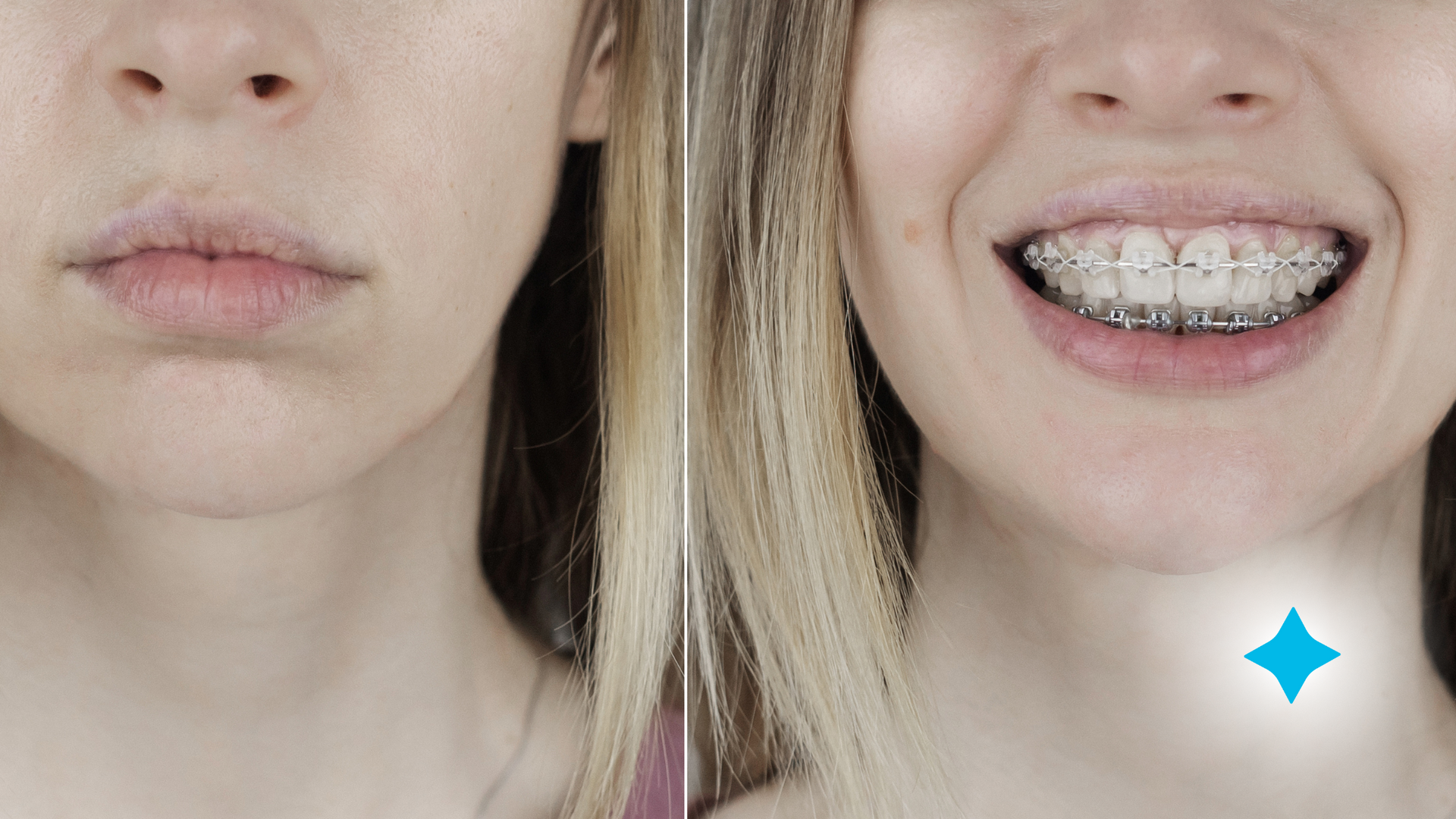 A before and after photo of a woman with braces on her teeth.