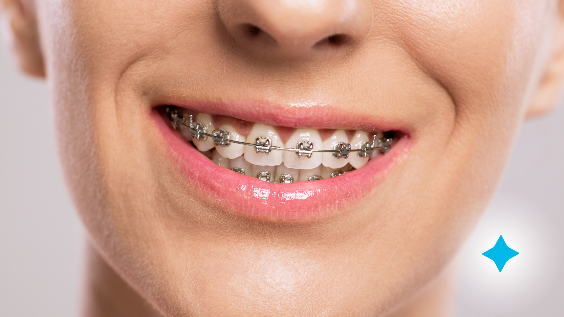 A close up of a woman 's mouth with braces on her teeth.