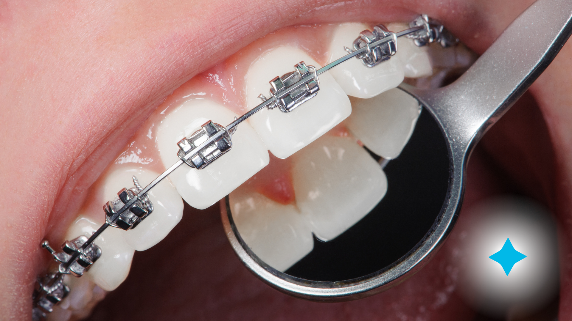A close up of a person 's teeth with braces and a mirror