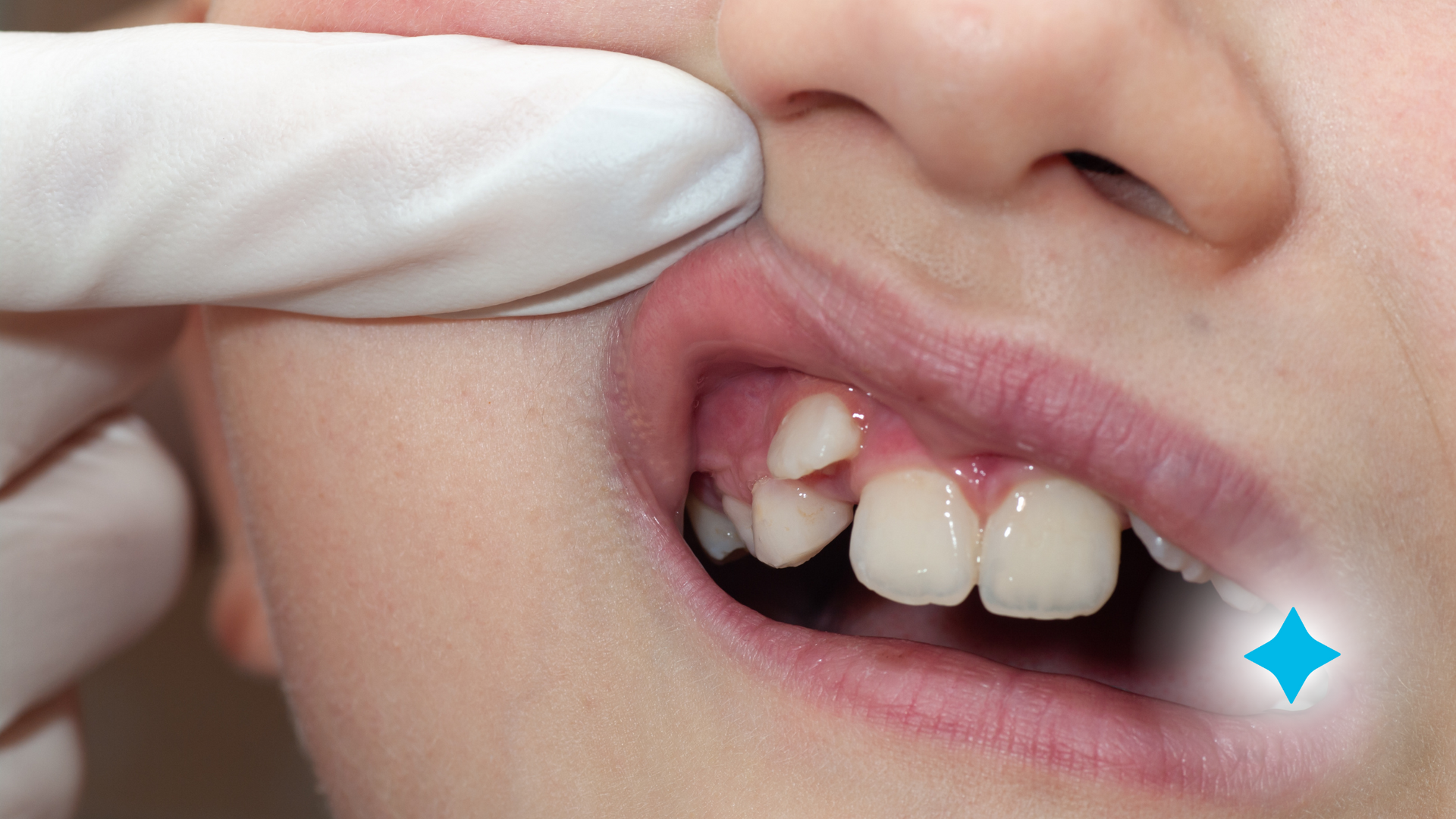 A close up of a child 's teeth being examined by a dentist.