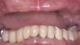 Close-up view of a dental bridge replacing lower front teeth, showing the teeth against the gum line.