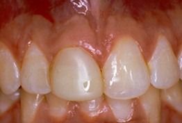 A close-up view of a person's upper front teeth and gums, showing gum tissue health and tooth alignment.