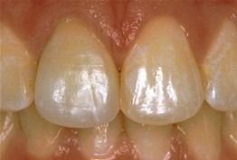 A close-up view of healthy, clean human upper front teeth and gums.