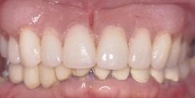 Close-up view of human teeth showing a straight upper arch and a crowded, overlapping lower arch.