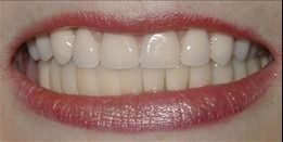 A close-up view of a smiling mouth, showing well-aligned, natural-looking upper and lower teeth.