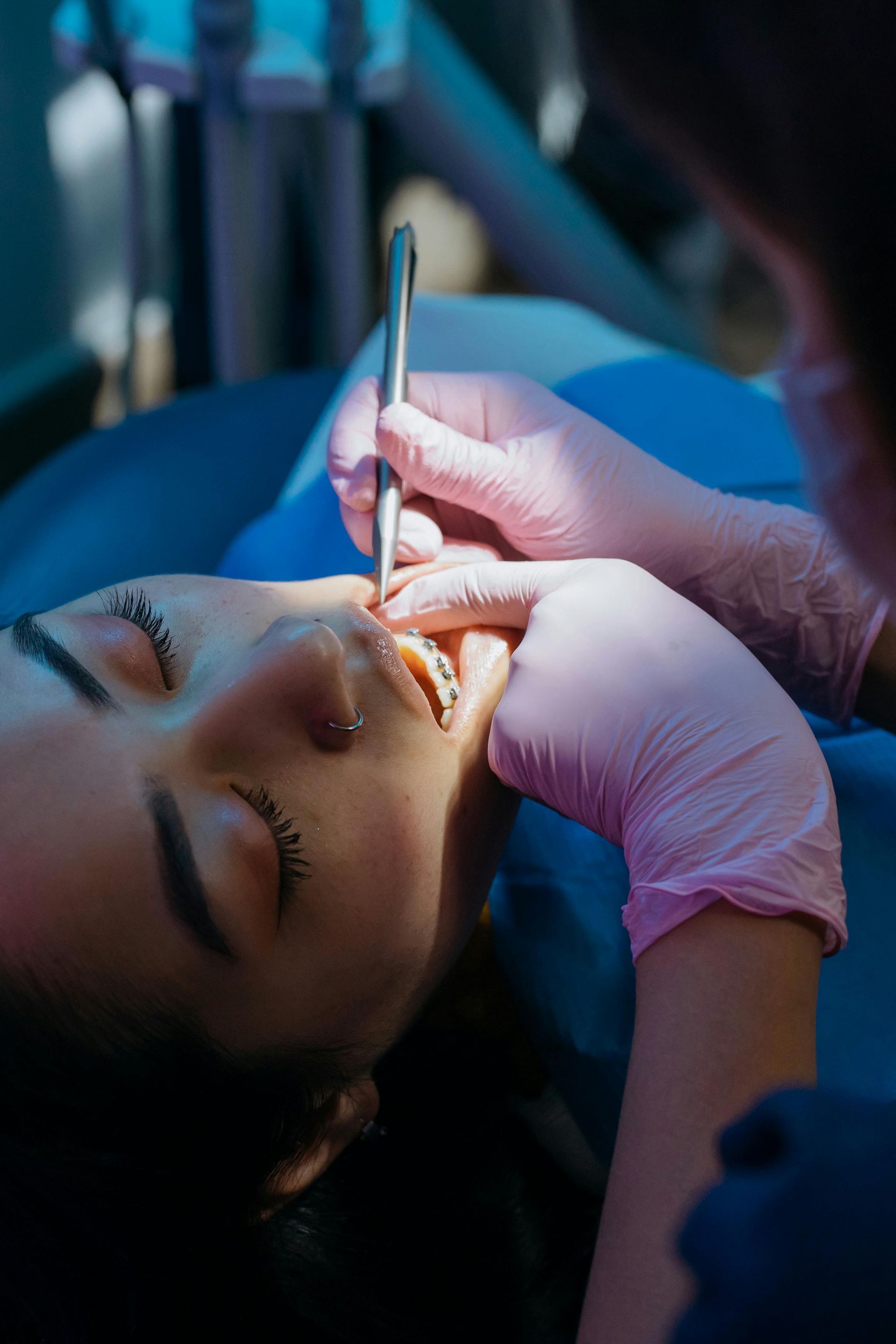 A dental model showing a single implant between two natural teeth, illustrating how an implant restores a missing tooth.