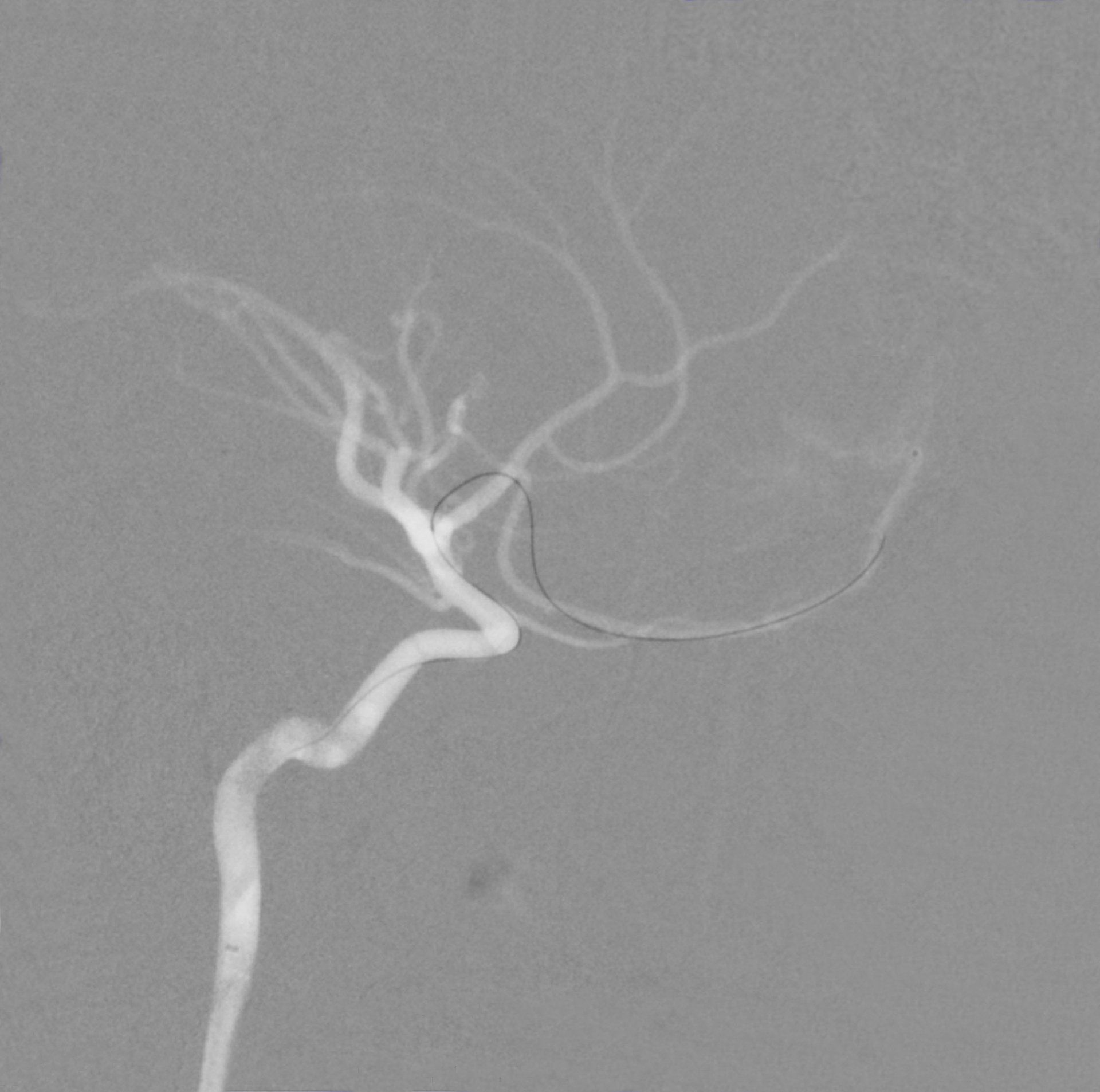 Angiogram of brain vasculature showing a catheter in a major artery, likely for intervention.